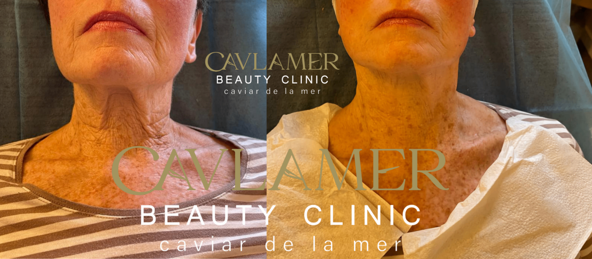 Before and after saggy neck treatment — jawline and neck contour lifted