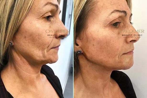 Before and after non-surgical face lift — tighter jowls and lifted cheekbones