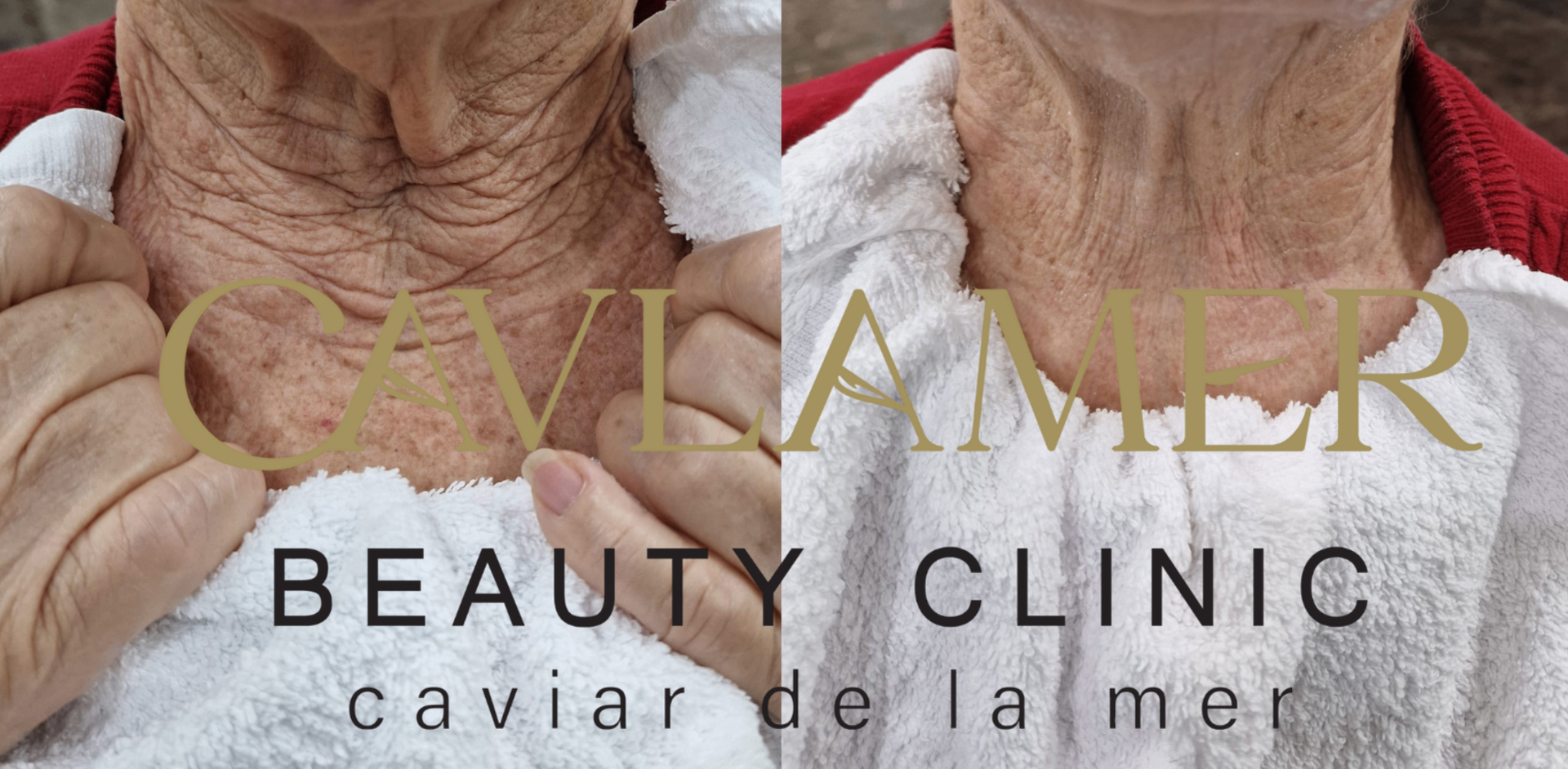 Before and after neck wrinkle treatment — smoother, firmer neck skin in mature client